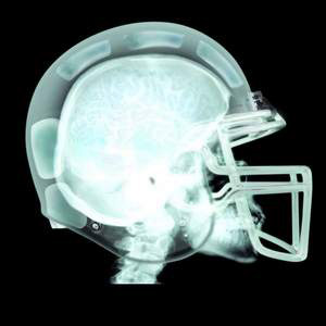 Concussions are harming student athletes